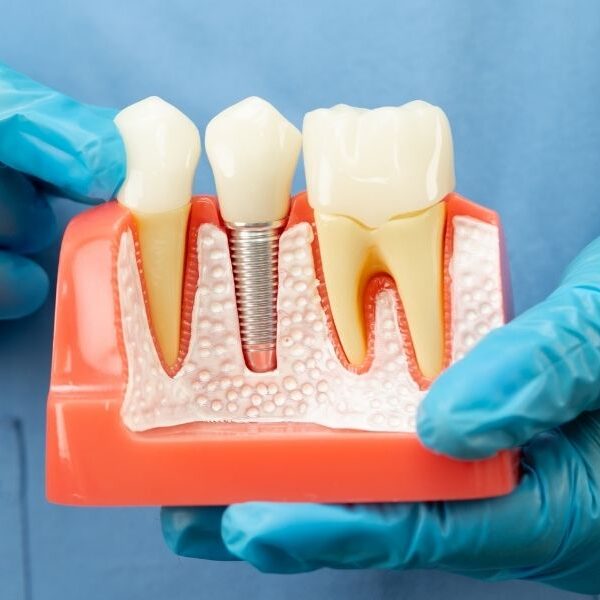 dental implant dental implant