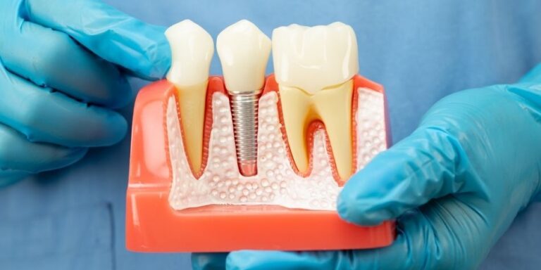 dental implant