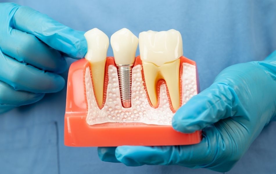 dental implant