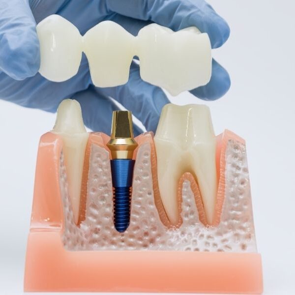 dental implant