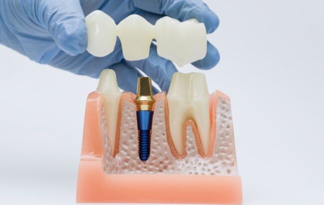dental implant