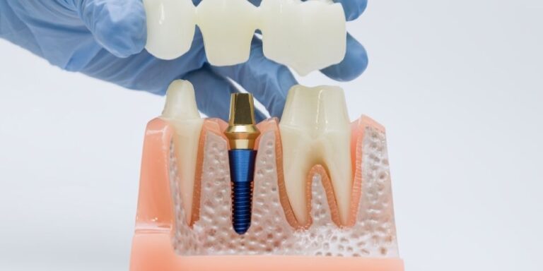 dental implant