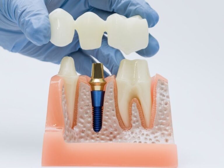 dental implant