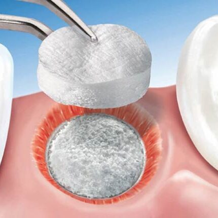 dental-surgeons-implant-center-bone-grafting