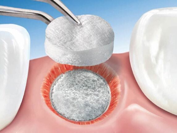 dental-surgeons-implant-center-bone-grafting