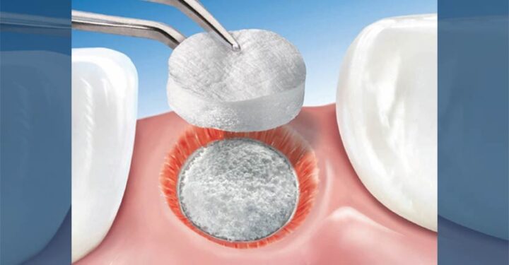 dental-surgeons-implant-center-bone-grafting