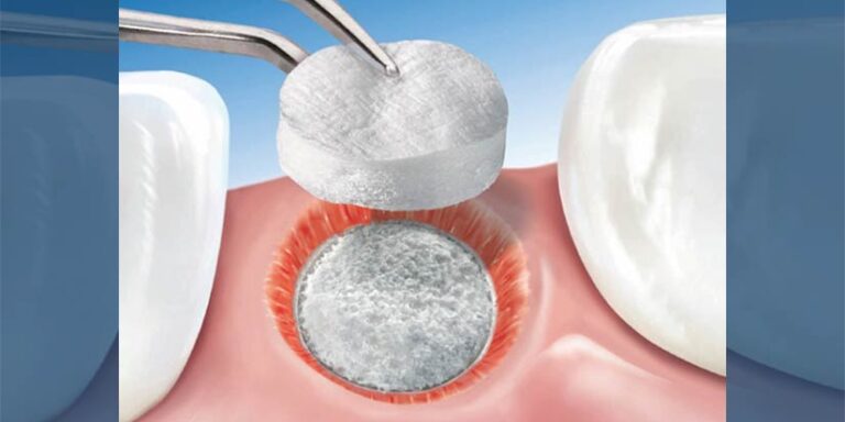 dental-surgeons-implant-center-bone-grafting