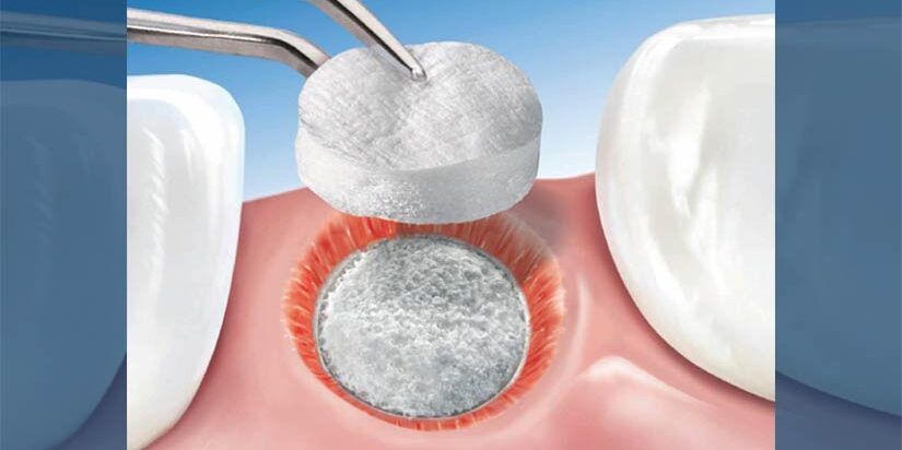 dental-surgeons-implant-center-bone-grafting dental-surgeons-implant-center-bone-grafting