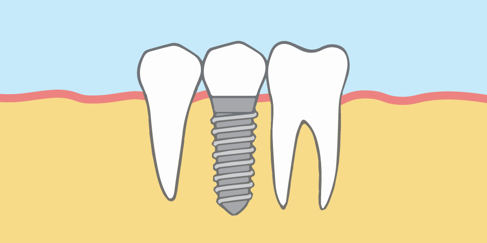 dental-surgeons-implant-center-implants