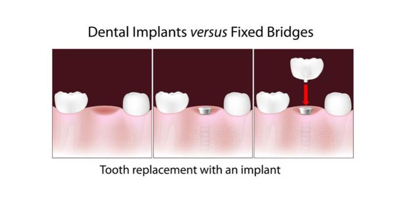 dental-surgeons-implant-center-implants