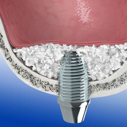 dental-surgeons-implant-center-sinus-lift-augmentation