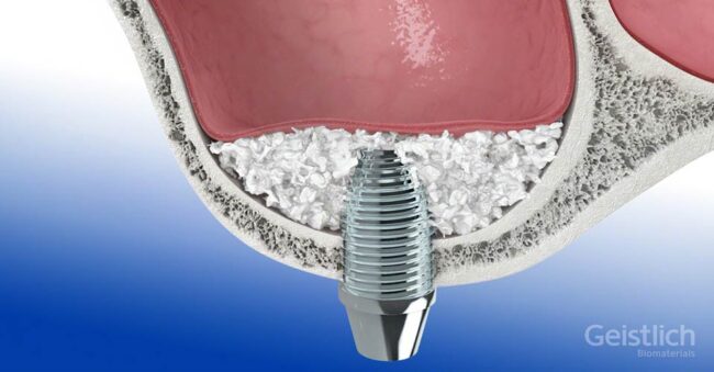 dental-surgeons-implant-center-sinus-lift-augmentation