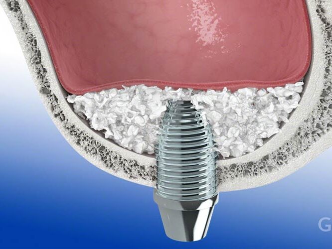 sinus augmentation