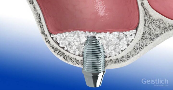 dental-surgeons-implant-center-sinus-lift-augmentation