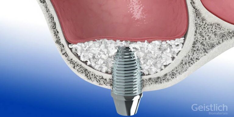 dental-surgeons-implant-center-sinus-lift-augmentation