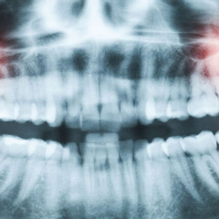 dental-surgeons-implant-center-wisdom-teeth-extraction-impacted