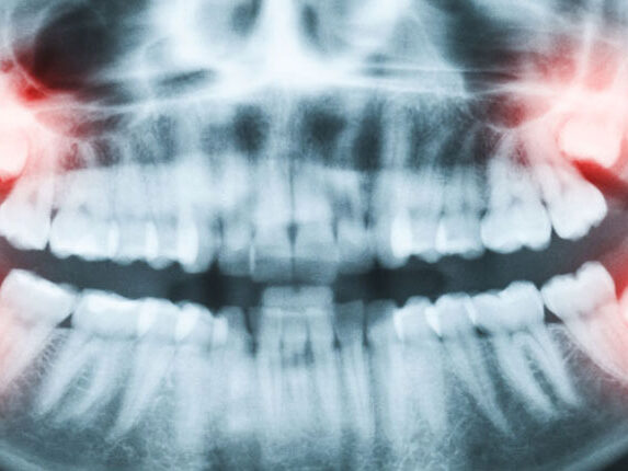 dental-surgeons-implant-center-wisdom-teeth-extraction-impacted
