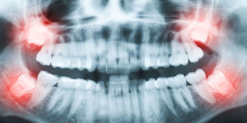 dental-surgeons-implant-center-wisdom-teeth-extraction-impacted dental-surgeons-implant-center-wisdom-teeth-extraction-impacted